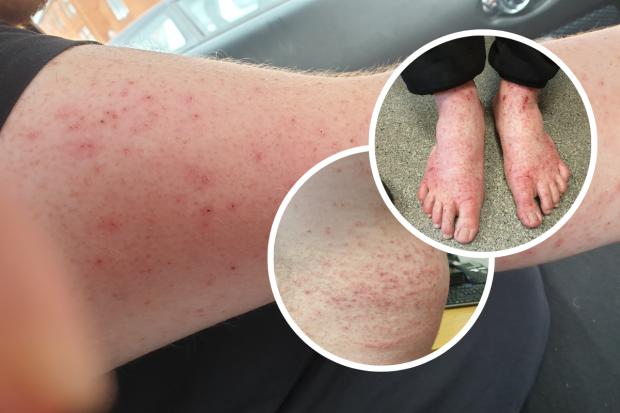 A La Ciotat House resident was taken to the minor injuries unit to be treated for bedbug bites. Pictures: Supplied